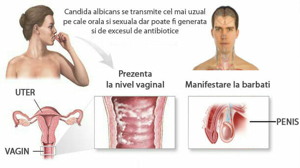 Ginecologie - Candidoza vaginala